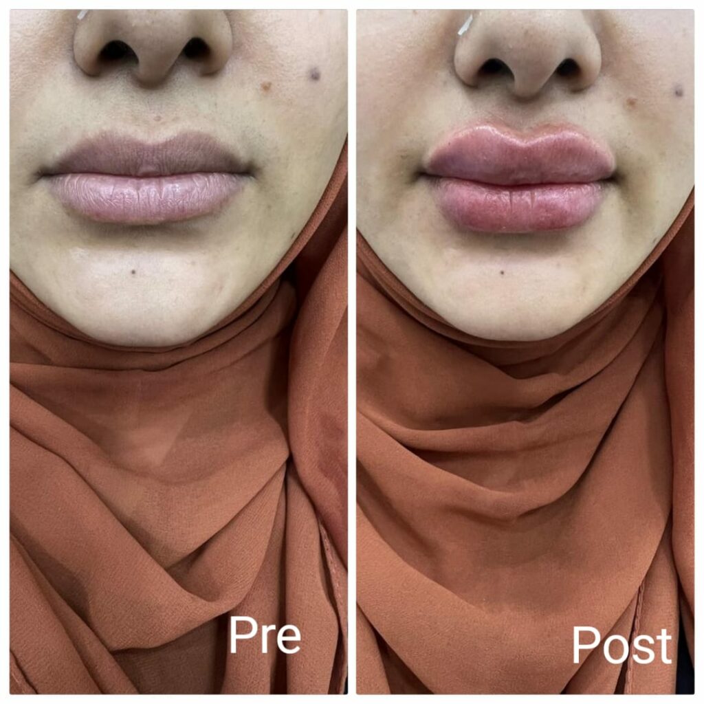 فيلر الشفايف